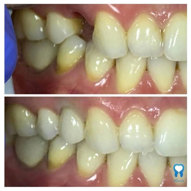 Zubni implantat - 4Smile