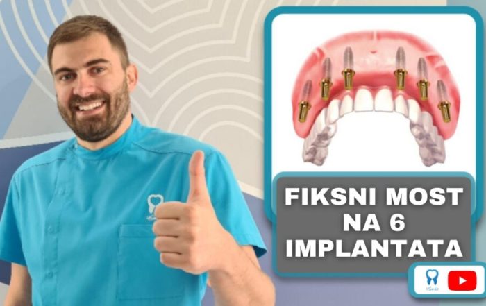 zubni-most-na-implantatima-video-blog