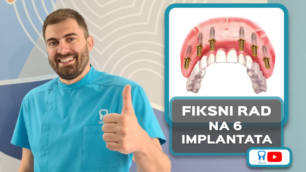 FIKSNI-RAD-NA-6-IMPLANTATA-VLOG-e1622119174961