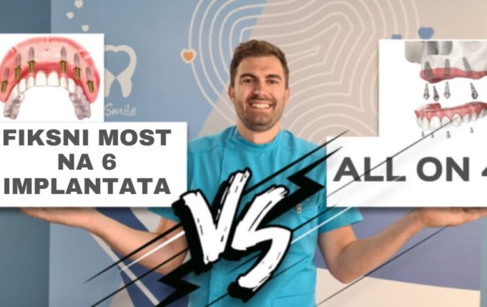 razlika-izmedu-fiksnog-mosta-na-6-implantata-i-tretmana-all-on-4-video-blog