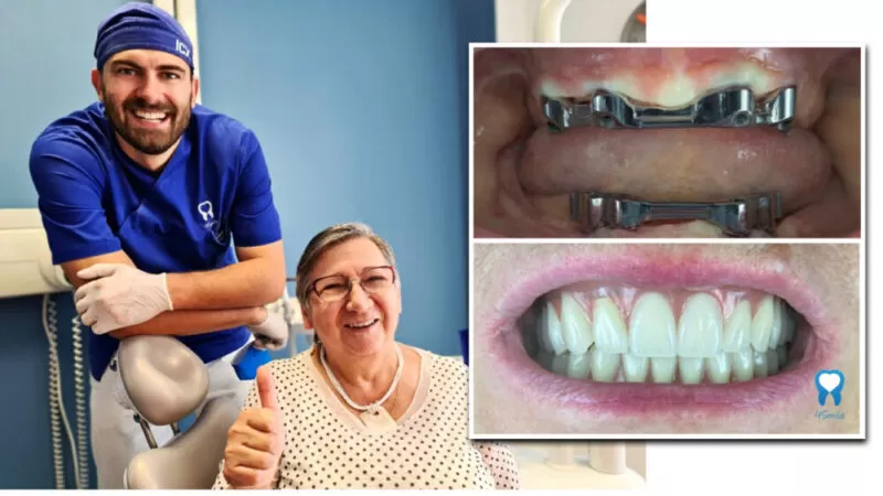 Polufiksna proteza na 4 implantata (proteza na prečki) već od 172€ mjesečno - 4Smile