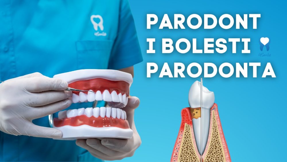 Parodont-i-bolesti-parodonta-4Smile
