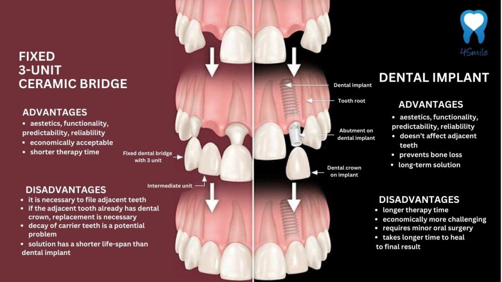 Dental bridge VS Dental Implant Dental bridge VS Dental Implant
