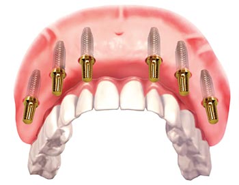 Dental Bridge with 6 implants