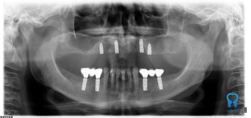 Panoramic X-ray after dental implant placement