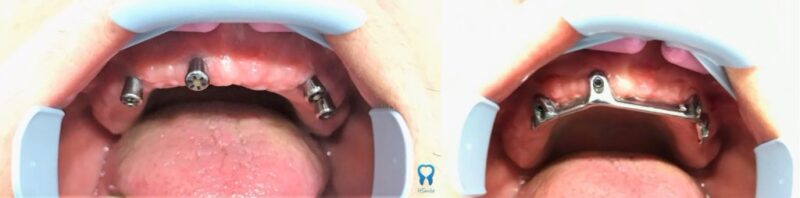 Placing gingival formers on implants and testing the bar