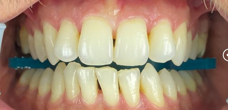 Before teeth whitening