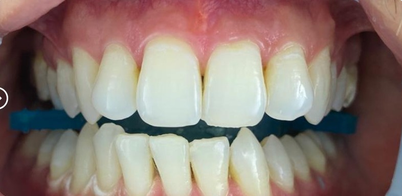 After teeth whitening