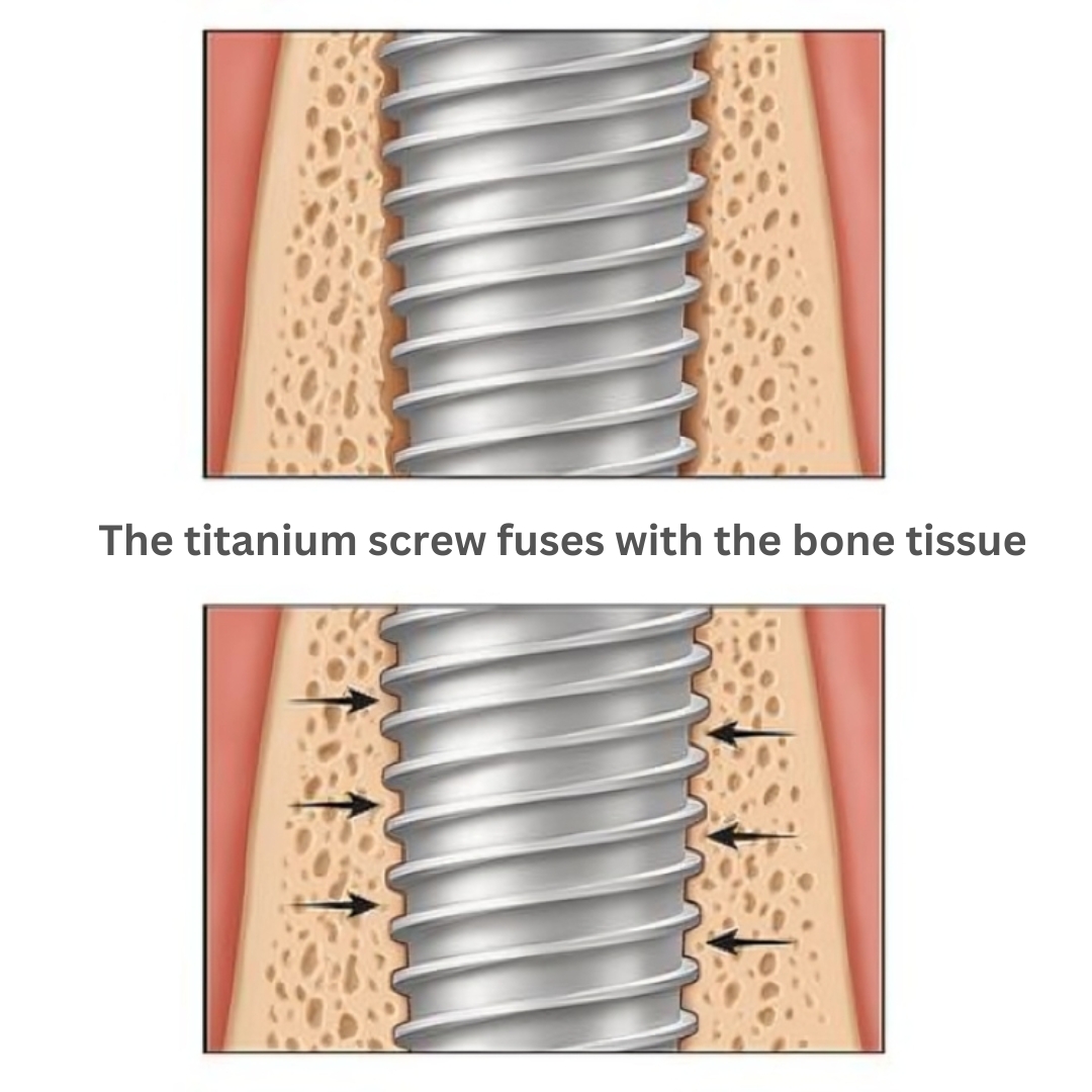 Titanium screw fusing with a dental implant
