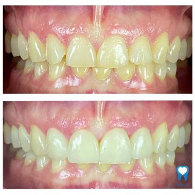 Dental Veneers - Before and After 1