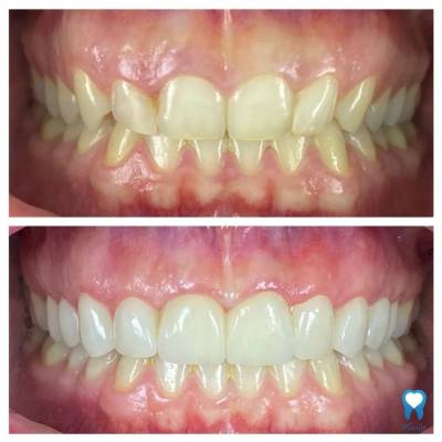 Dental Veneers - Before and After 2