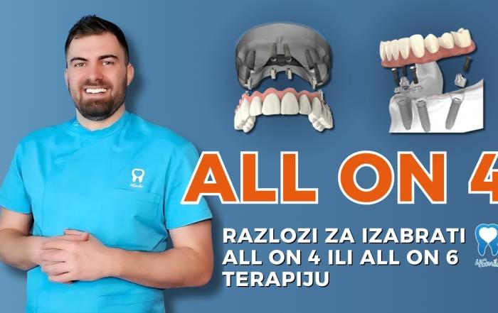 all-on-4-razlozi-za-izabrati-all-on-4-ili-all-on-6-terapiju