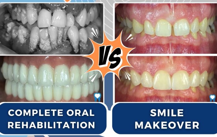 difference-between-complete-oral-rehabilitation-and-smile-makeover