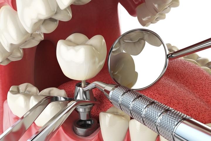 Dental Implantation