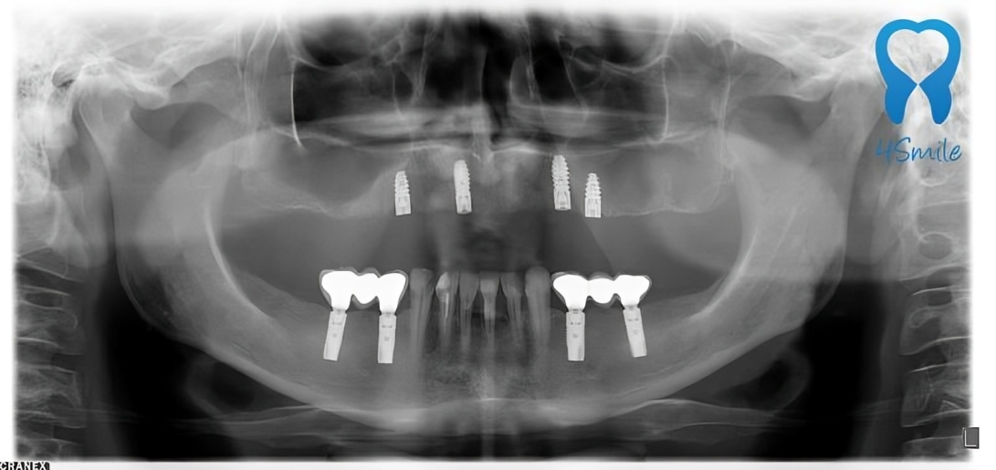 Dental Implant Jaw Xray