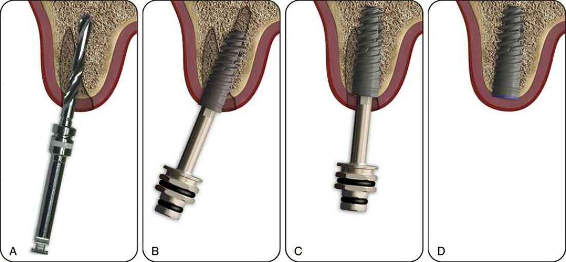 Dental Implantation And Osseointegration