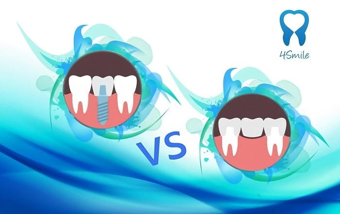 dental-implant-or-ceramic-dental-bridge-which-is-better