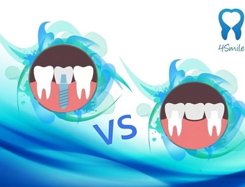 Dental Implant or Ceramic Dental Bridge: Which Is Better?