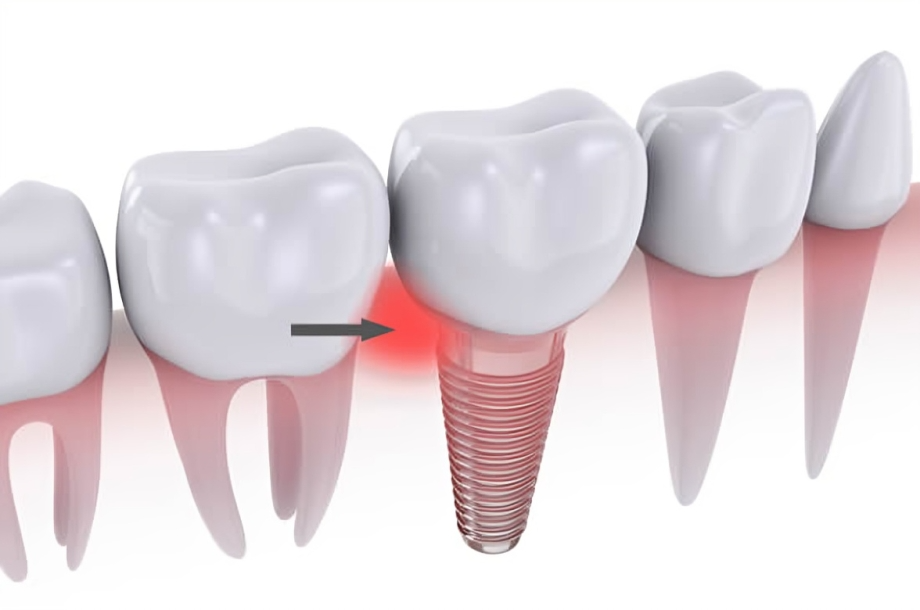 Dental Implant Complications
