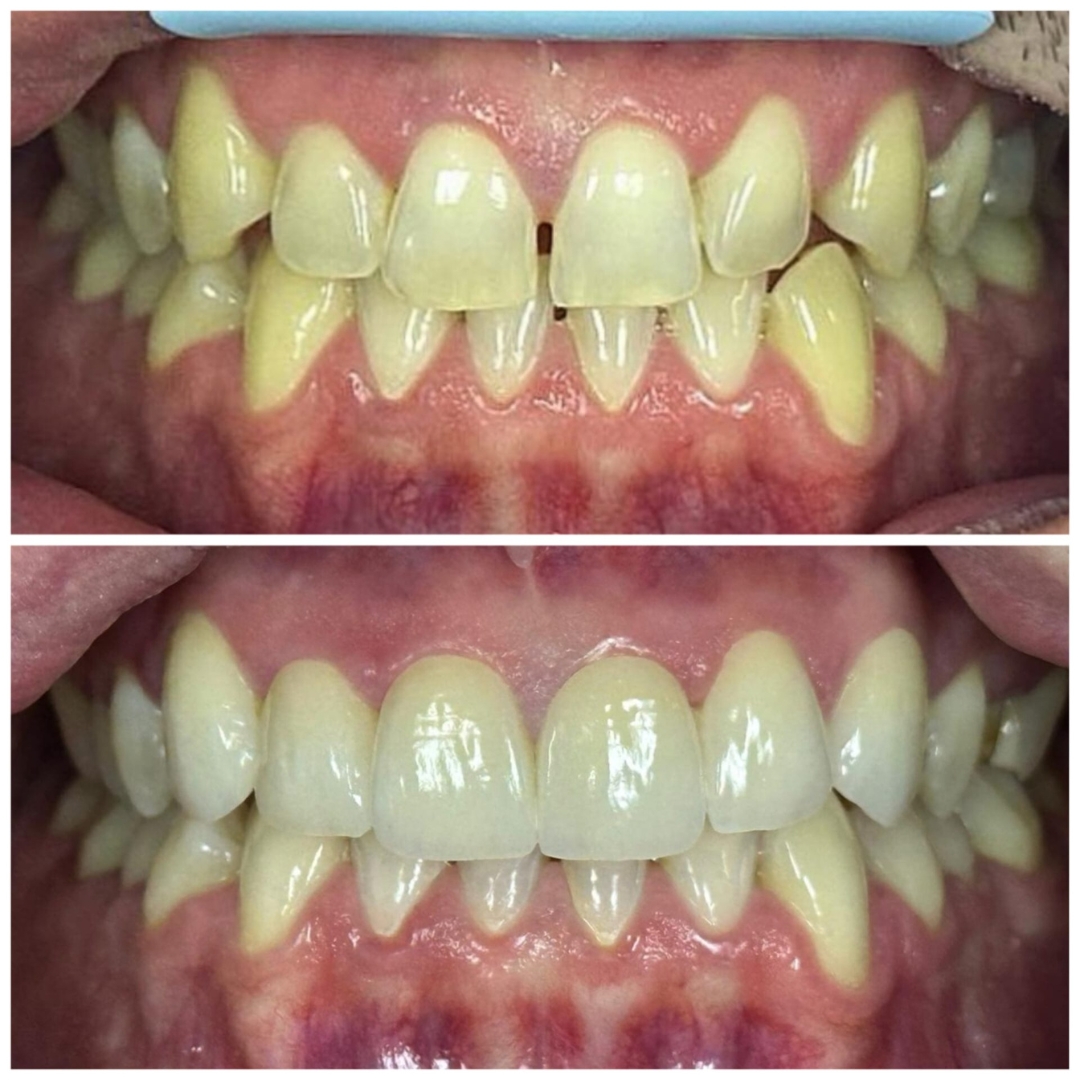 Closing diastema and changing the color and shape of teeth