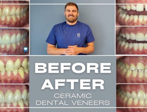 BEFORE AND AFTER: 5 TRANSFORMATIONS WITH CERAMIC DENTAL VENEERS