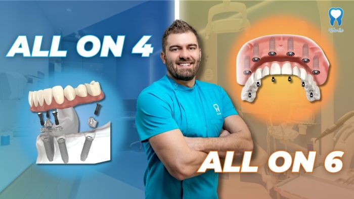 the-difference-between-all-on-4-and-all-on-6-dental-implants