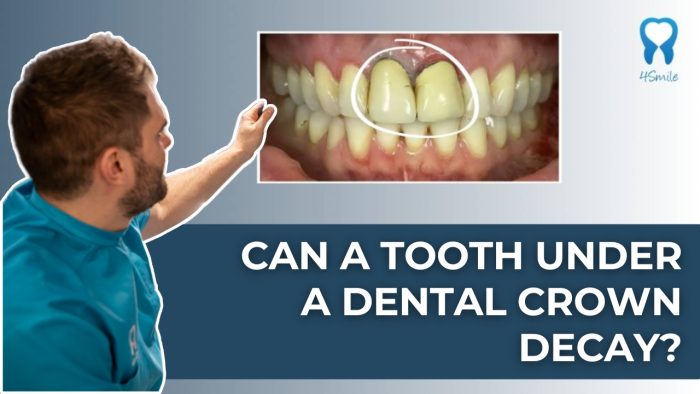 can-a-tooth-under-a-dental-crown-decay