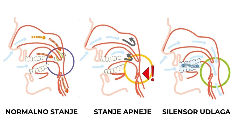 Udlaga protiv hrkanja i apneja Udlaga protiv hrkanja i apneja