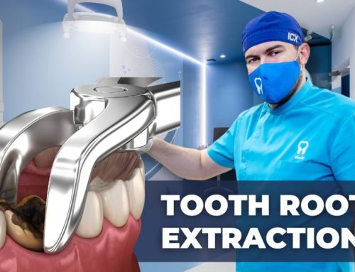 Tooth Root Extraction: Everything You Need to Know