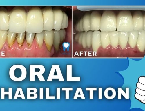 Case study – Oral rehabilitation with dental implants