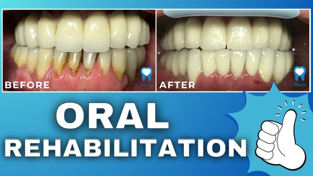 case-study-oral-rehabilitation-with-dental-implants