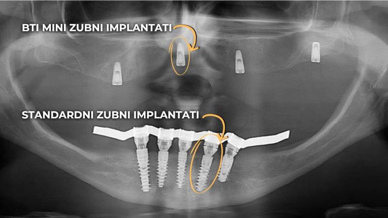 BTI zubni implantati VS Standardni zubni implantati