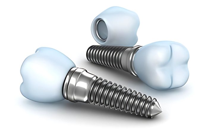 who-saved-our-smile-the-history-of-dental-implants