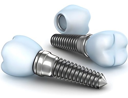 Who Saved Our Smile? – The History of Dental Implants