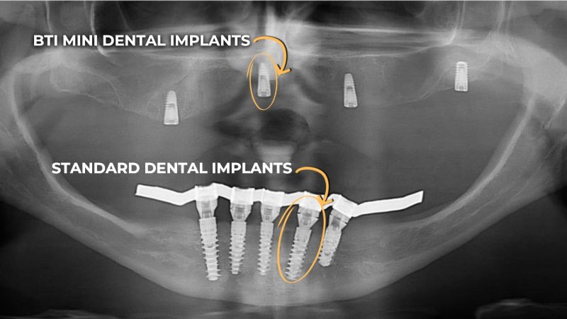 BTI MINI ZUBNI IMPLANTATI (3)