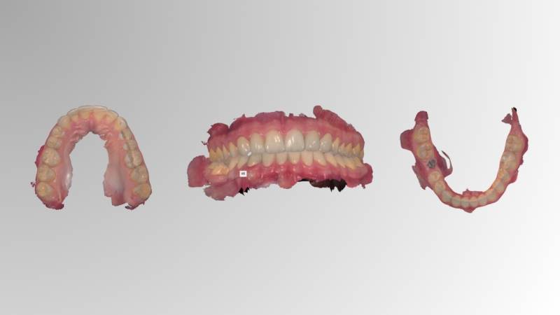 Dental Impression Digital Scans