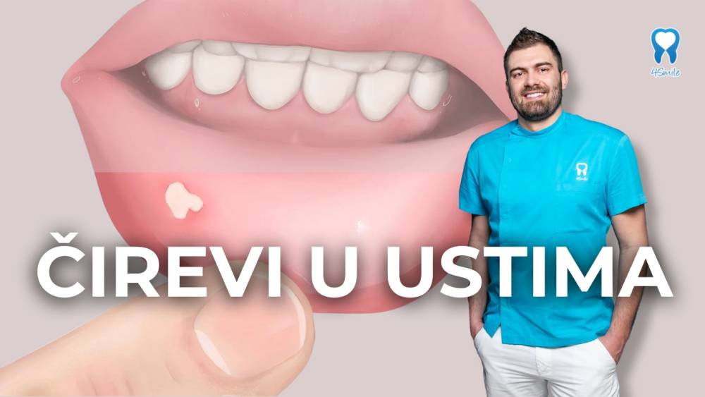cirevi-u-ustima-uzroci-simptomi-i-kako-ih-lijeciti cirevi-u-ustima-uzroci-simptomi-i-kako-ih-lijeciti