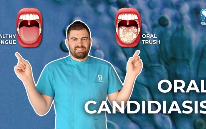 oral-candidiasis-oral-trush