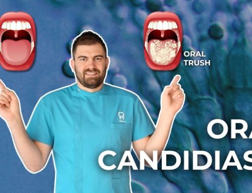 Oral candidiasis – Oral trush