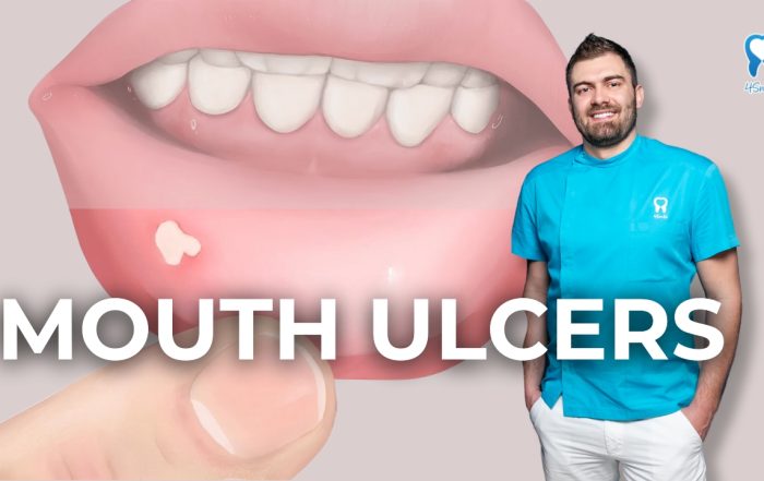 mouth-ulcers