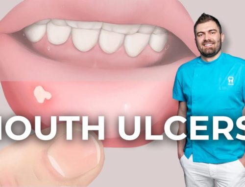 Mouth Ulcers