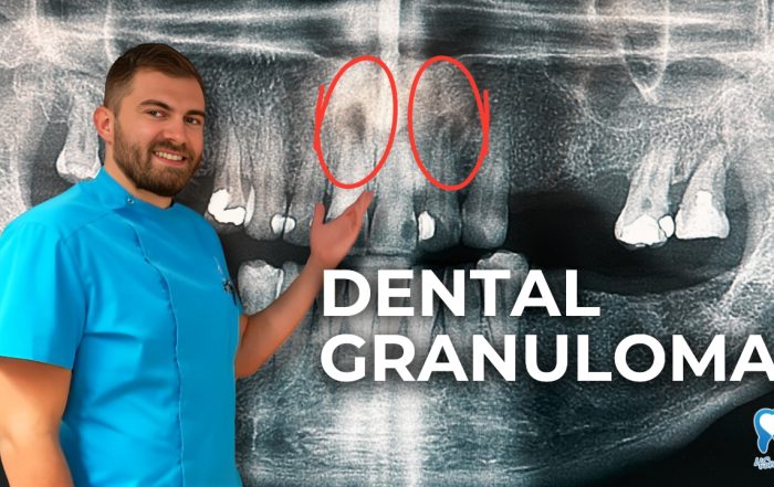 dental-granuloma-everything-you-need-to-know