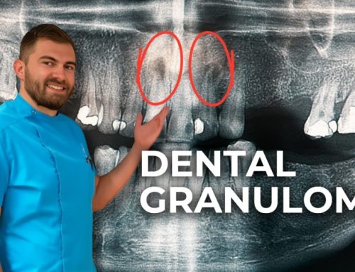 Dental granuloma – Everything you need to know