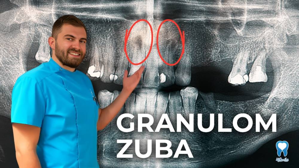 granulom-zuba-sve-sto-trebate-znati granulom-zuba-sve-sto-trebate-znati