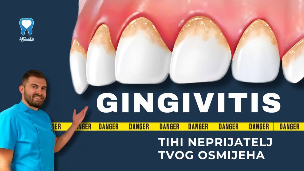 gingivitis-tihi-neprijatelj-tvog-osmijeha gingivitis-tihi-neprijatelj-tvog-osmijeha