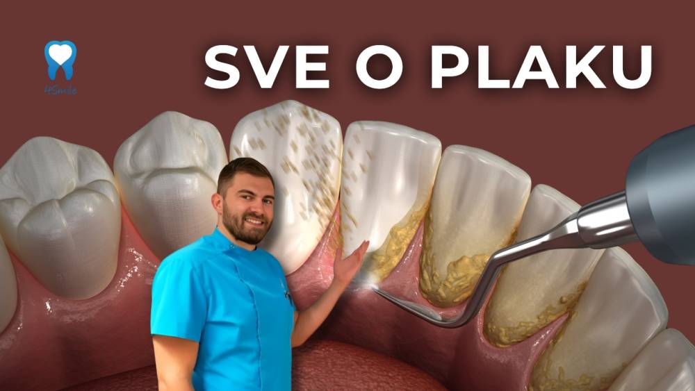 zasto-neki-ljudi-imaju-vise-plaka-i-posljedicno-vise-zubnog-kamenca zasto-neki-ljudi-imaju-vise-plaka-i-posljedicno-vise-zubnog-kamenca