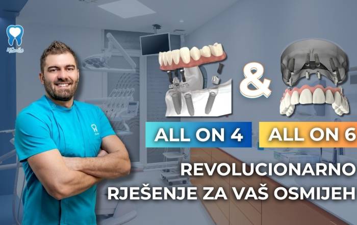 revolucionarno-rjesenje-za-vas-osmijeh-all-on-4-i-all-on-6-terapije-u-dental-centru-4smile