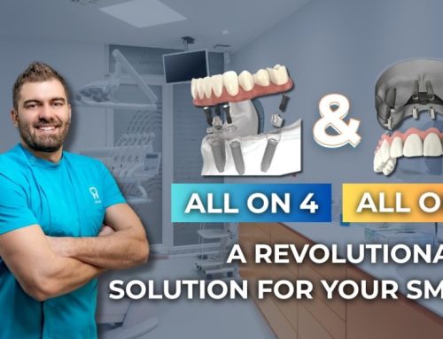 A revolutionary solution for your smile: All on 4 and All on 6 treatments at Dental Center 4Smile