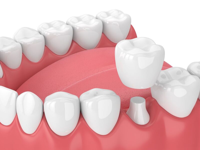 Ceramic Dental Crown Ceramic Dental Crown