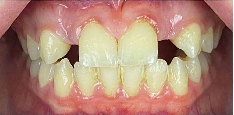 Hypodontia – Initial State